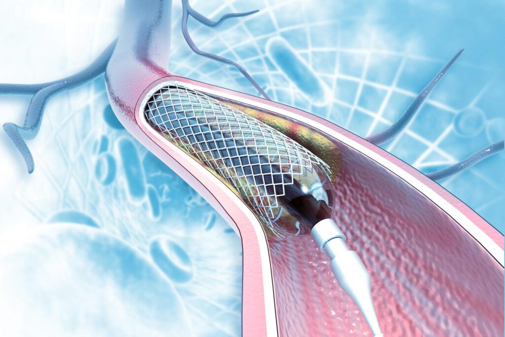 Angiography & Angioplasty